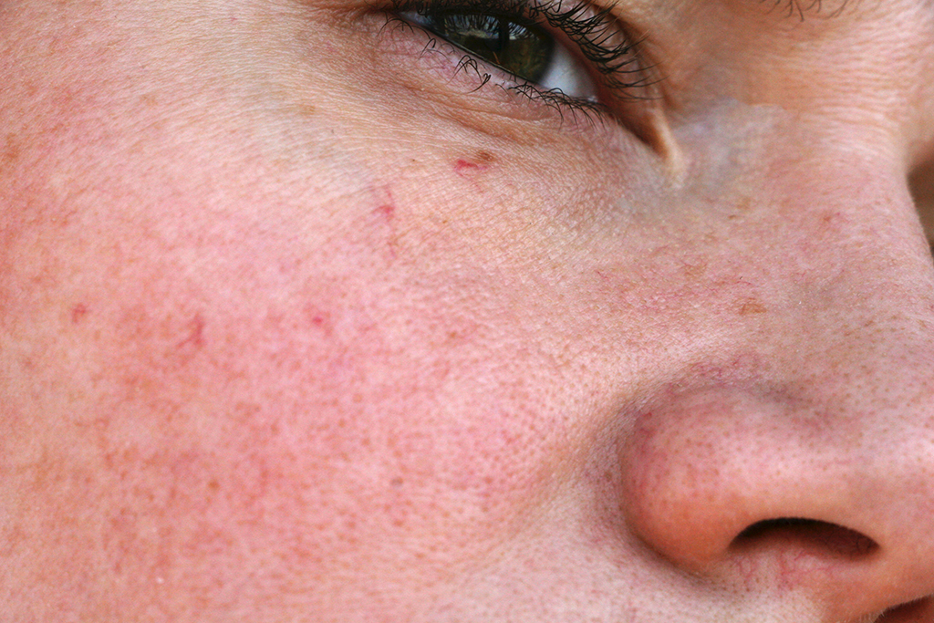 Sensitiv hud med sorte prikker